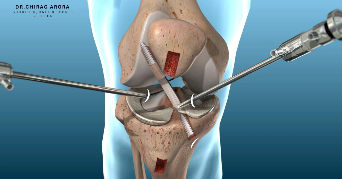 You are currently viewing Graft Options for Ligament Surgeries / ACL