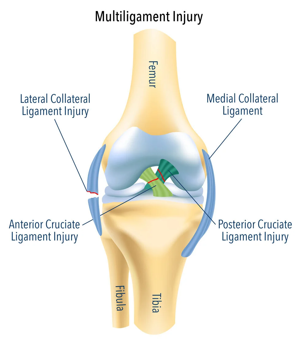 Multiligament Knee Injury: