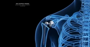 Read more about the article Patient Education Guide for Shoulder Replacement Surgery