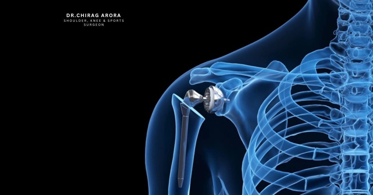 Read more about the article Patient Education Guide for Shoulder Replacement Surgery
