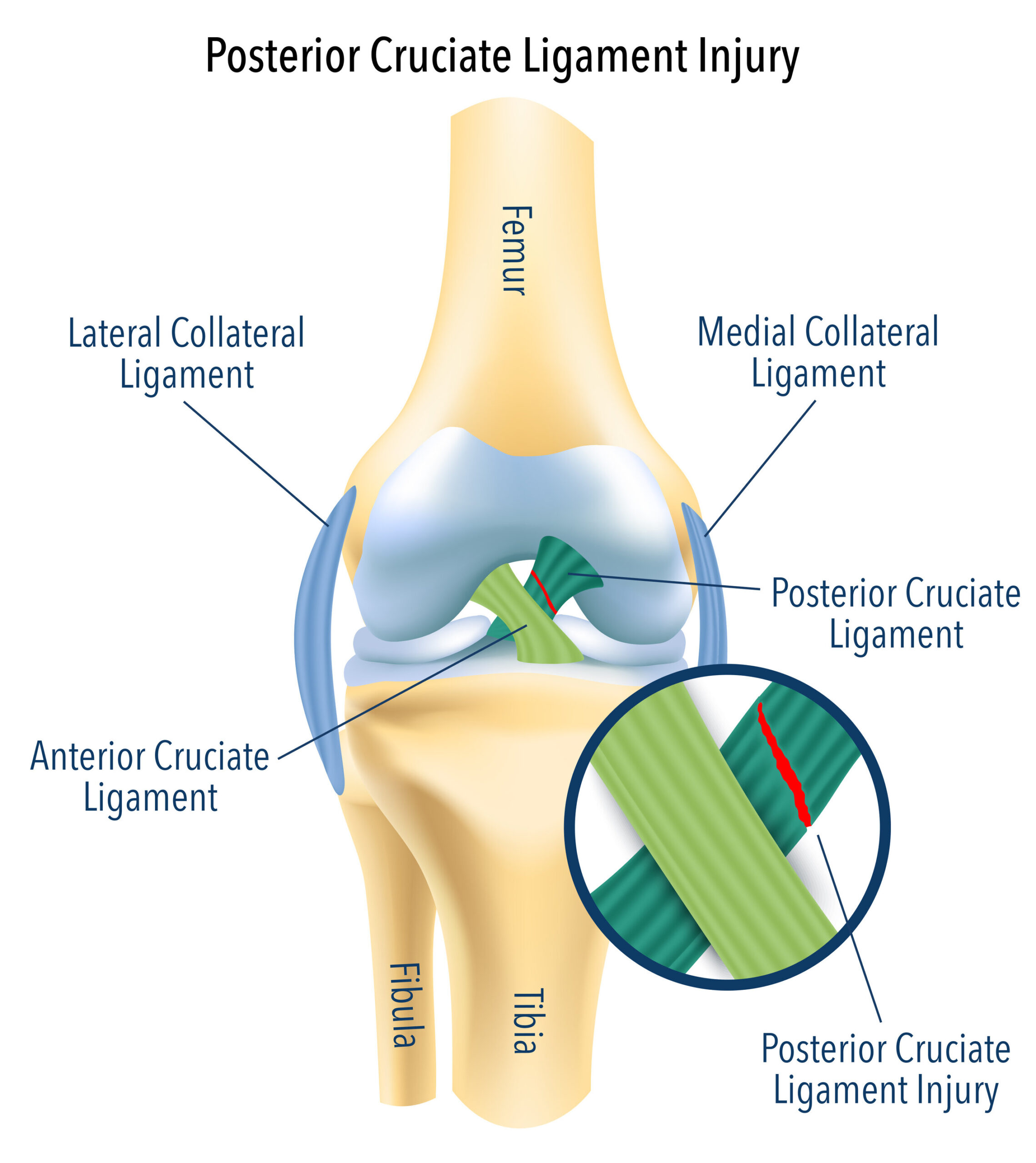PCL (Posterior Cruciate Ligament) Injury