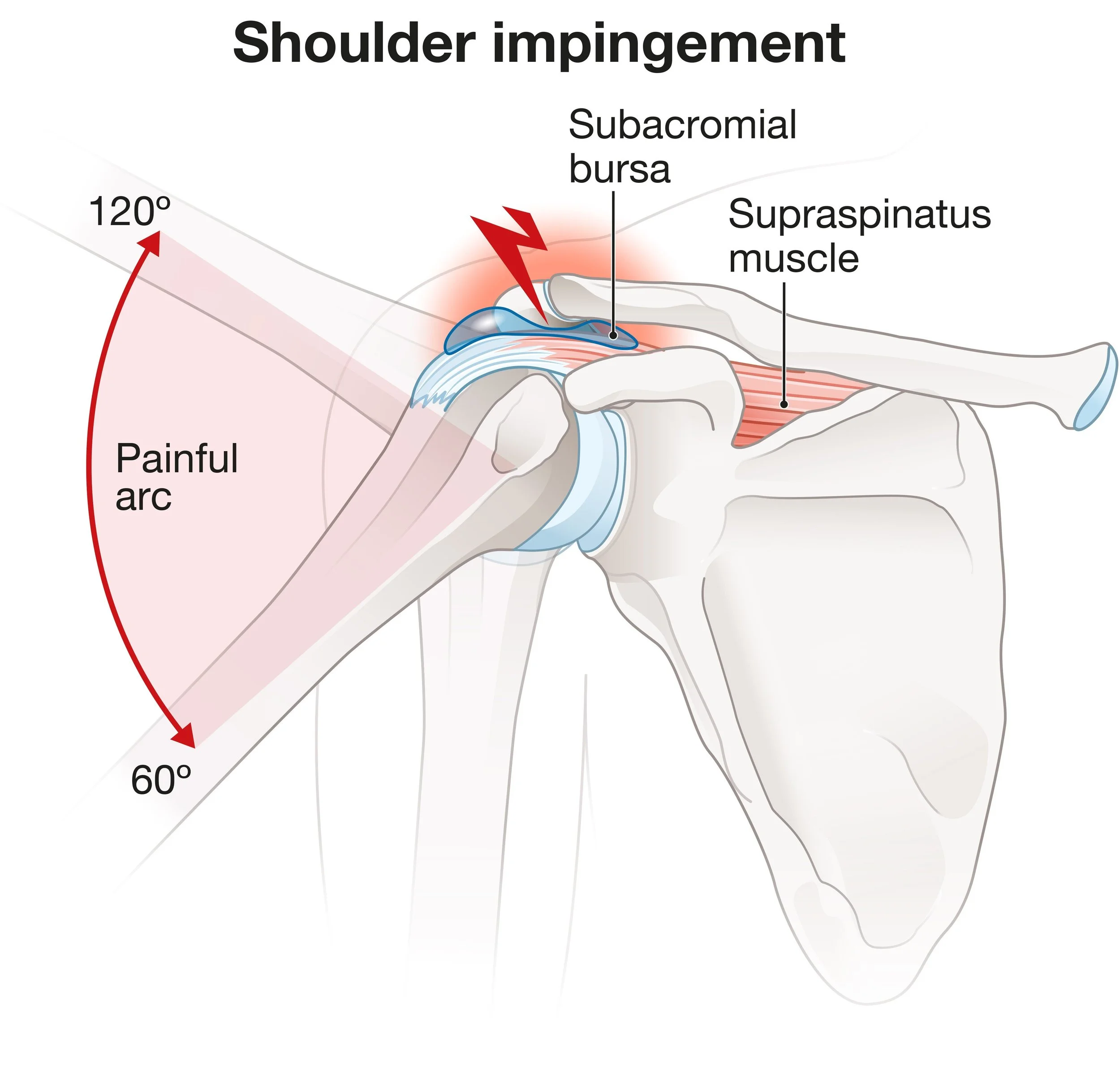 Shoulder Impingement Syndrome: