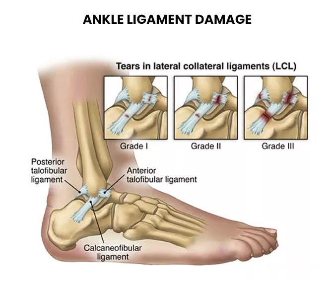 Ankle Ligament