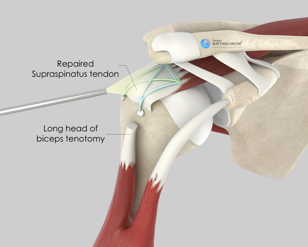 Arthroscopic Rotater Cuff repair