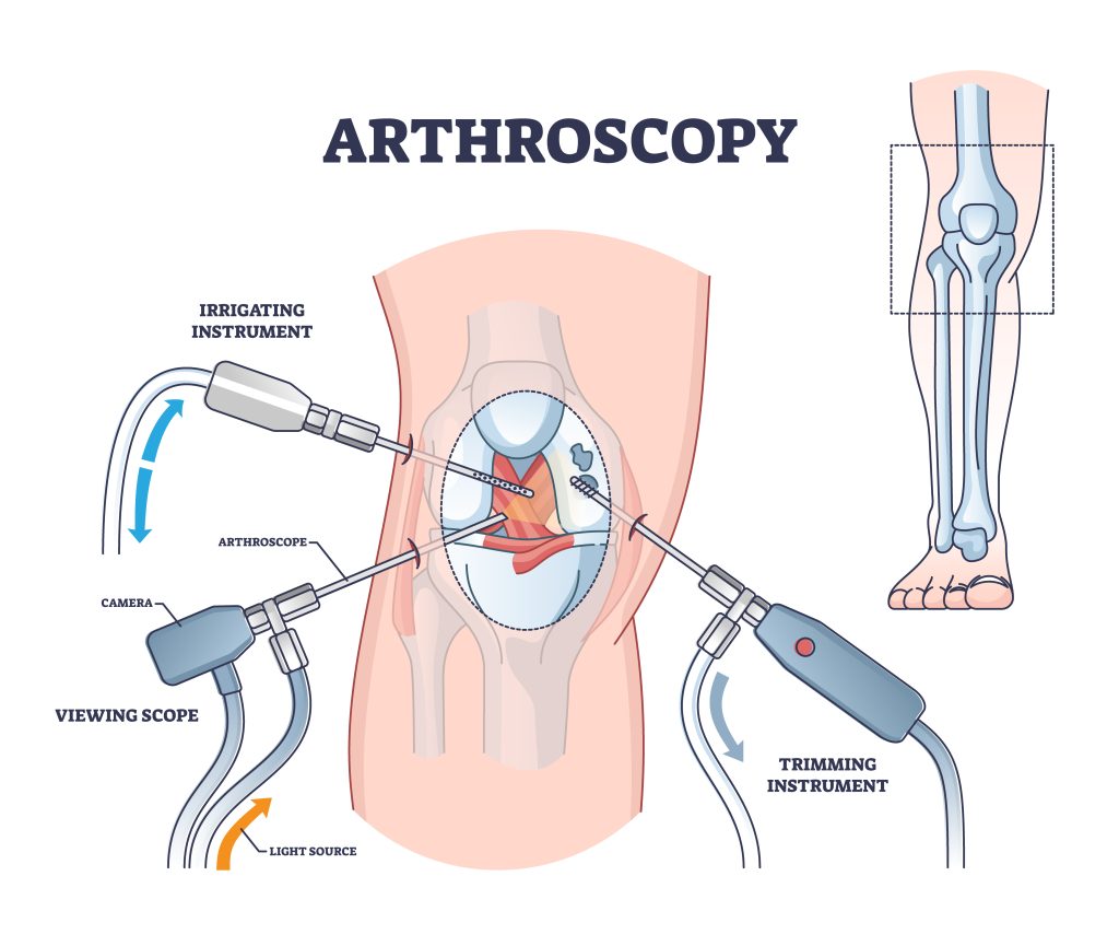Arthroscopic Surgeries