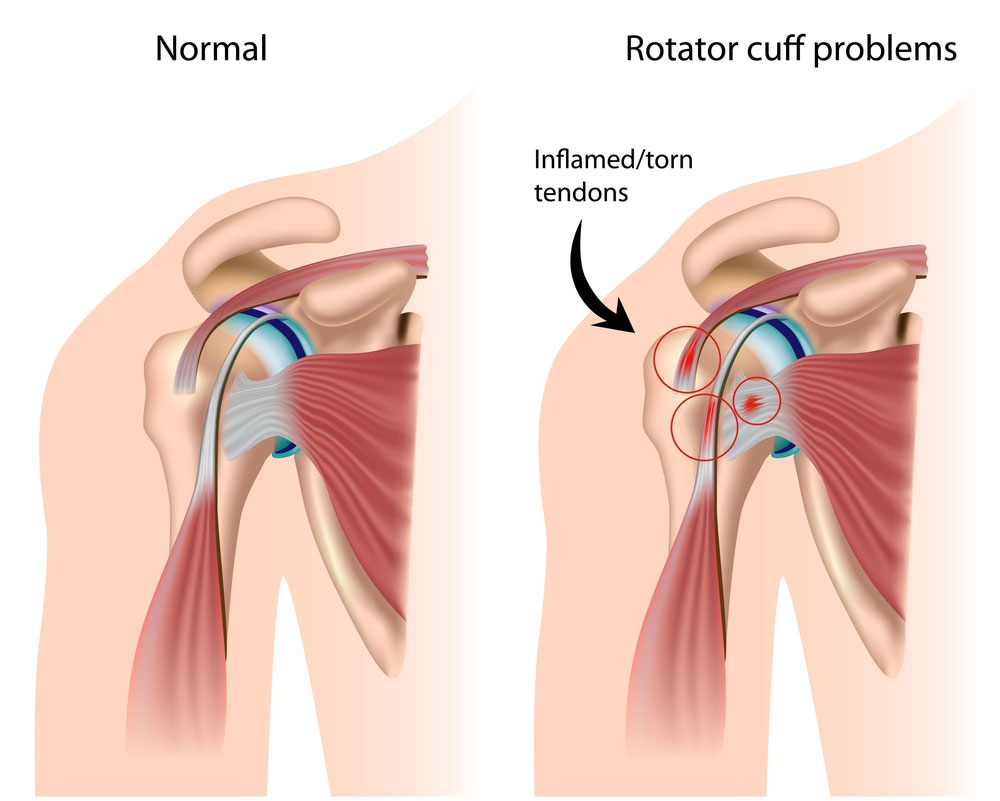 Arthroscopic Rotator Cuff Repair