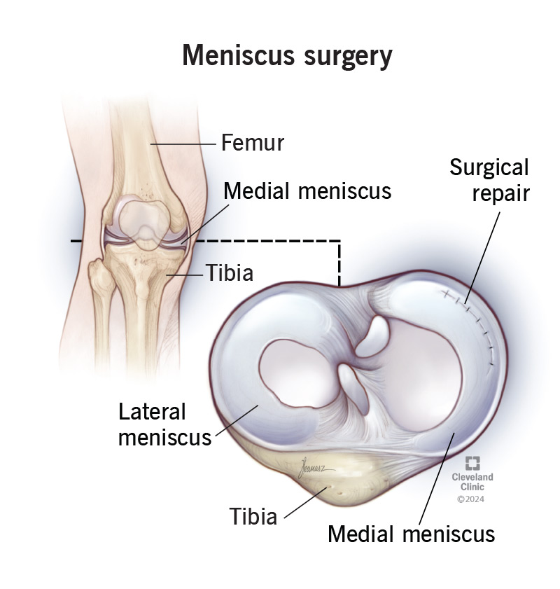 Meniscus Repair