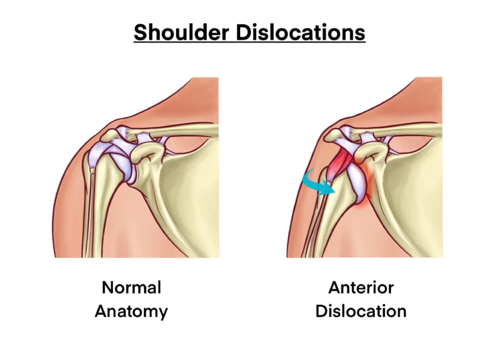 Recurrent Shoulder Dislocation Surgeries