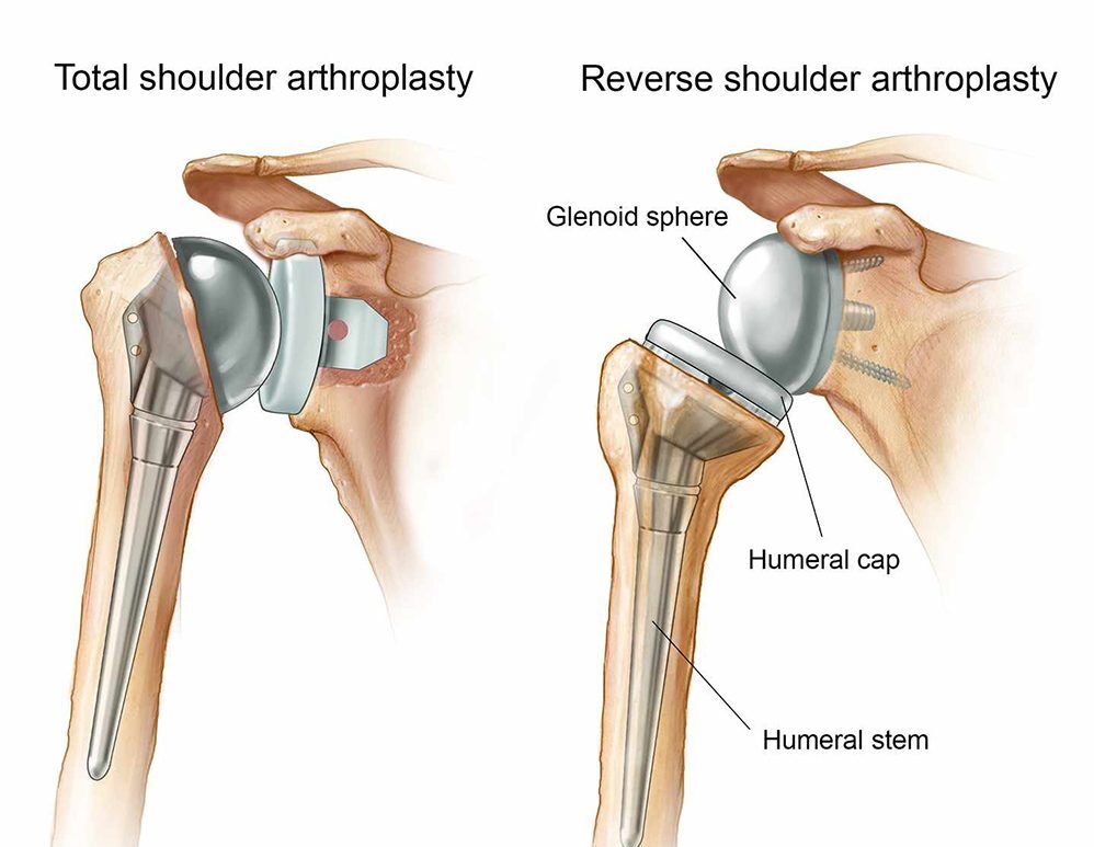 Shoulder Replacement