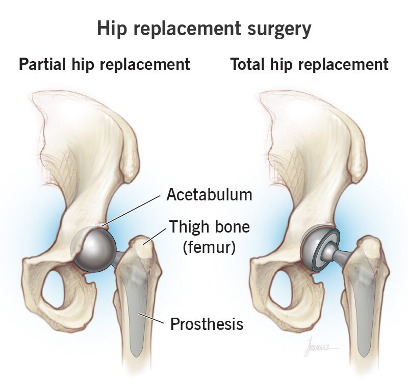 Hip Replacement