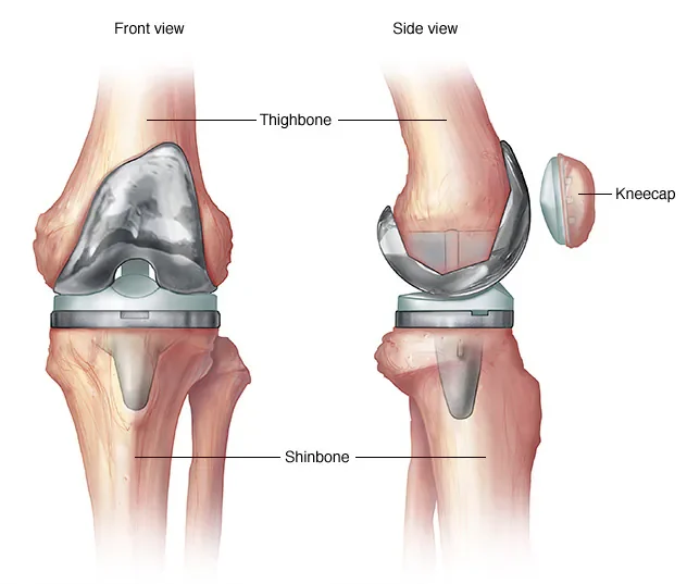 Knee Replacement